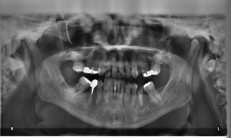 Los empastes de mercurio lo que debes saber - Número 18 Dental Notting Hill dental