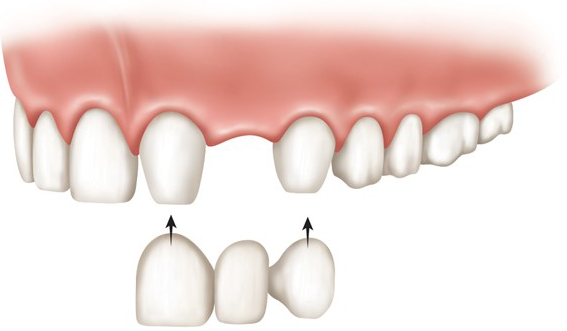 Dental bridge