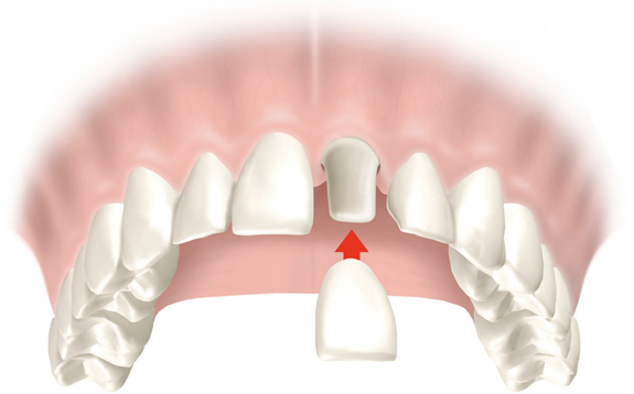 Dental crowns