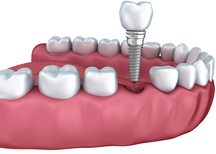 Dental implant