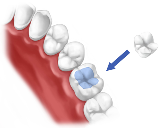 Dental inlays and onlays