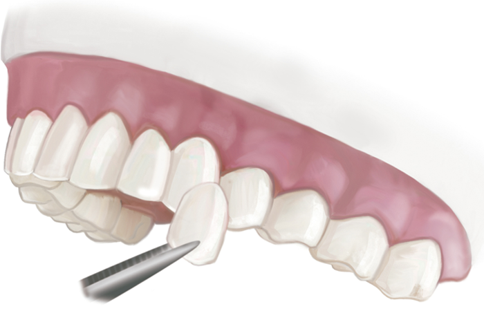 Dental veneer