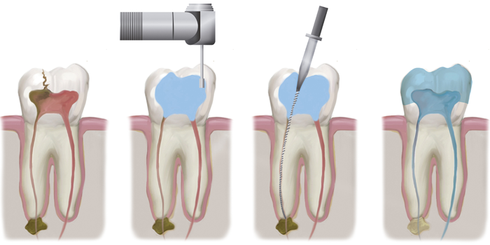 Root canal treatment